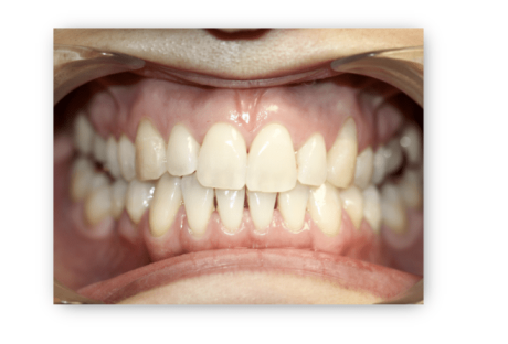 What Causes Black Triangle Teeth